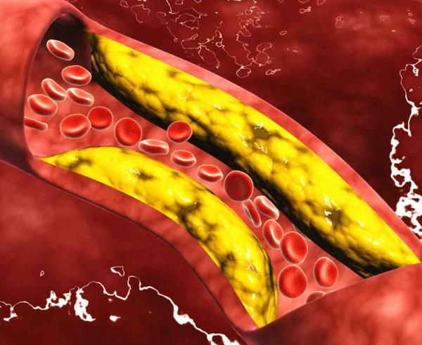 6 Signs Your Cholesterol Might Be Too High