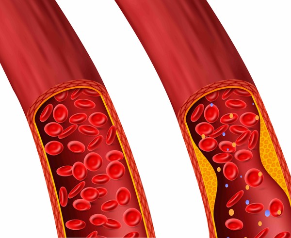 Top 10 Things Triggering High Cholesterol