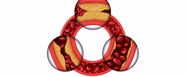 6 Signs Your TG/HDL Ratio Needs Attention