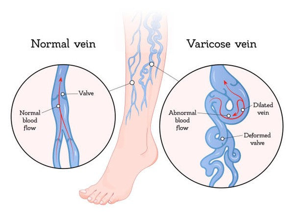ELIMINATING VARICOSE VEINS