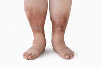 Fluid Retention <br>(Swollen Legs or Ankles)