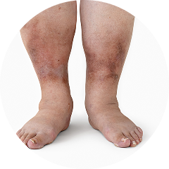 Excess Water Retention