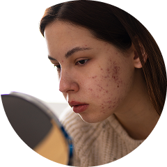 Skin Breakouts or Dullness